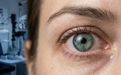 Sécheresse oculaire et chirurgie réfractive : ce qu’il faut savoir avant de se lancer