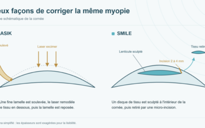 SMILE ou LASIK : comment choisir ? Le guide d’un chirurgien réfractif à Montpellier