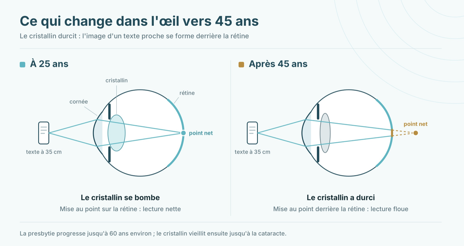 Schéma de l’œil à 25 ans et après 45 ans : le cristallin durci fait la mise au point derrière la rétine